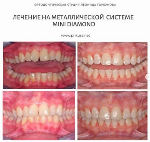 Брекеты до и после. Как брекеты меняют форму лица — фото до и после